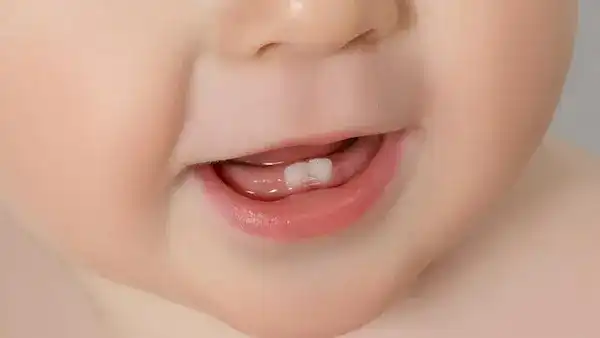 تسنين الأطفال