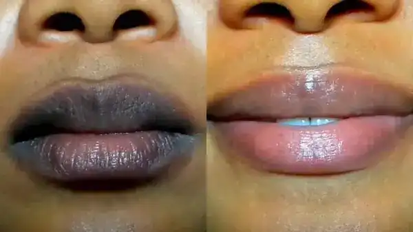 اسمرار الشفاه