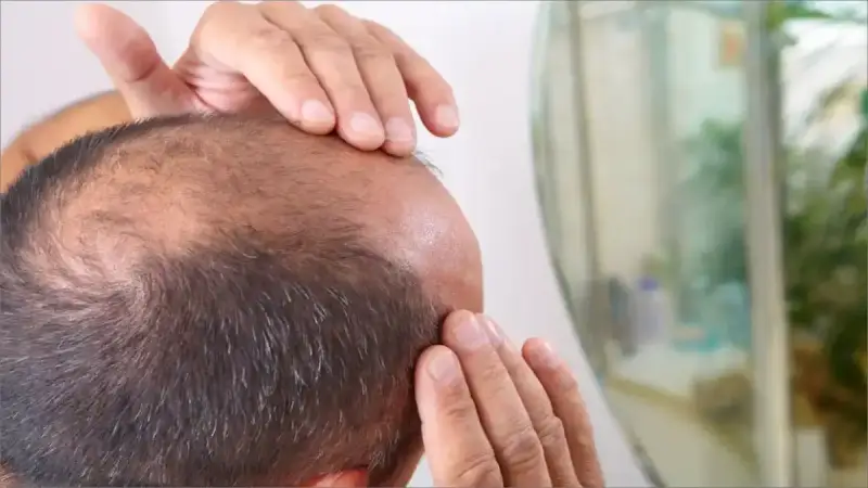 علاج غير متوقع للصلع الوراثي