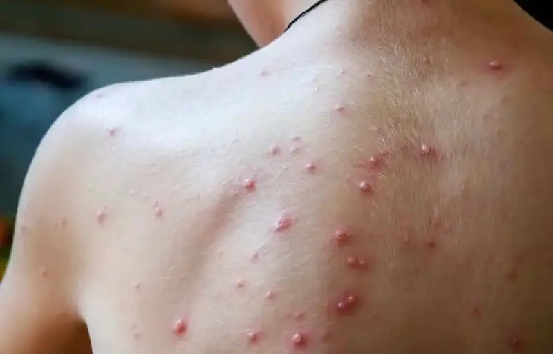 جدري القردة