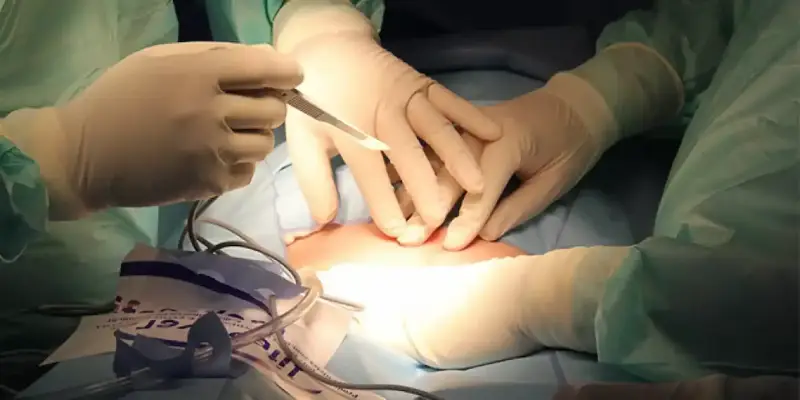العملية القيصرية