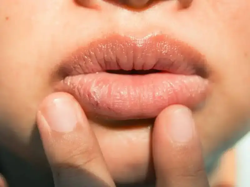 هل نقص الفيتامينات هو السبب وراء جفاف الشفاه؟
