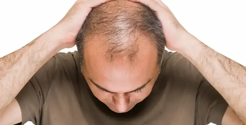 مشروبات تزيد من خطر الإصابة بالصلع
