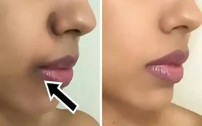 أسباب البقع الداكنة على الشفاه ومحيط الفم