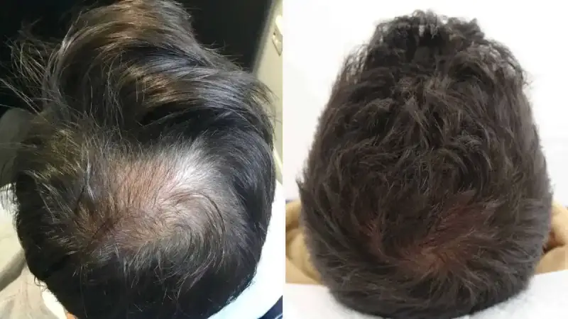 زراعة الشعر