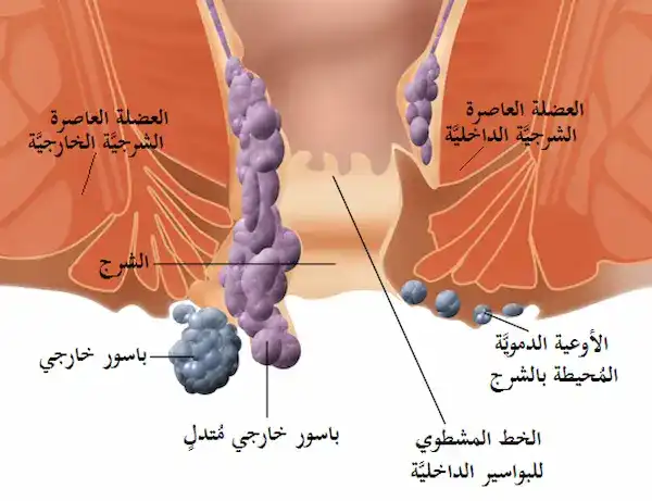 البواسير الداخلية
