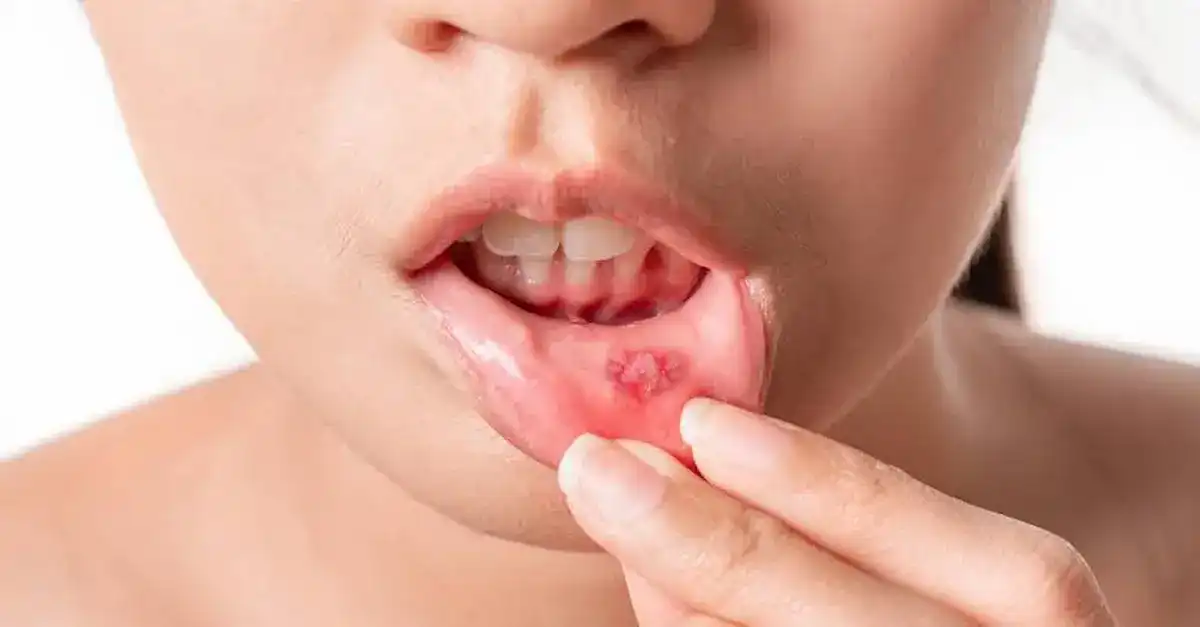 علاجات منزلية لقرحة الفم