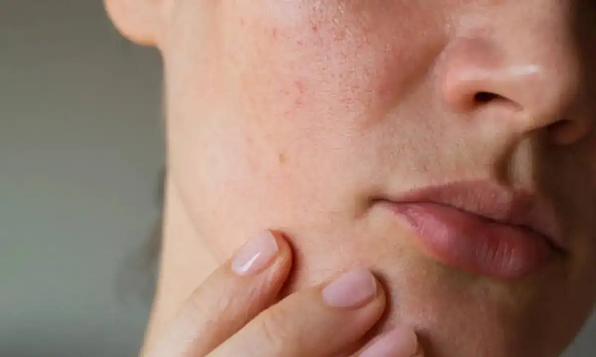 أمراض الجلد الناتجة عن التغيرات الهرمونية عند النساء