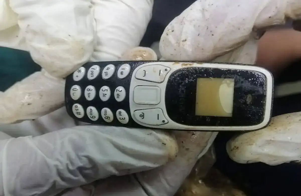 استخراج هاتف من معدة مصري بعد عامين من ابتلاعه